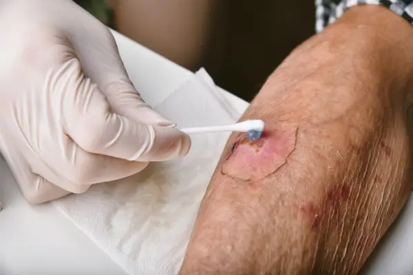 A lábamputáció súlyos lábszerfekély esetén is elkerülhető megfelelő fekélykezeléssel és lökéshullám terápiával